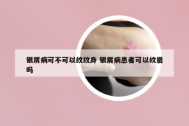 银屑病可不可以纹纹身 银屑病患者可以纹眉吗