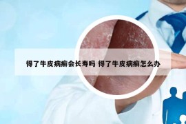 得了牛皮病癣会长寿吗 得了牛皮病癣怎么办