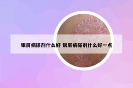 银屑病搽剂什么好 银屑病搽剂什么好一点