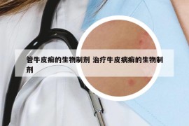 管牛皮癣的生物制剂 治疗牛皮病癣的生物制剂