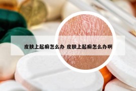 皮肤上起癣怎么办 皮肤上起癣怎么办啊