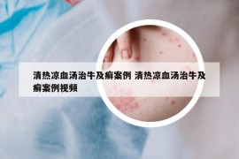 清热凉血汤治牛及癣案例 清热凉血汤治牛及癣案例视频