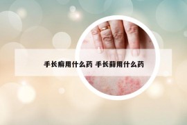 手长癣用什么药 手长藓用什么药