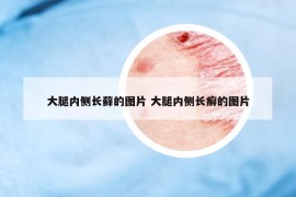 大腿内侧长藓的图片 大腿内侧长癣的图片