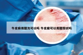 牛皮癣用醋洗可以吗 牛皮廨可以用醋擦拭吗