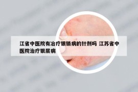 江省中医院有冶疗银销病的针剂吗 江苏省中医院治疗银屑病