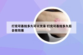 打完可善挺多久可以洗澡 打完可善挺多久后会有效果