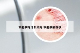 银翘病吃什么药好 银翘病的症状