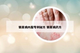 银屑病内服专利秘方 银屑病药方