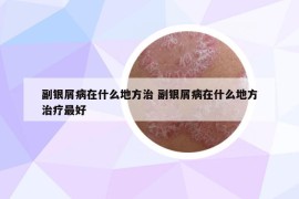 副银屑病在什么地方治 副银屑病在什么地方治疗最好