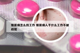 银屑病怎么找工作 银屑病人干什么工作不被歧视