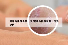 掌跖角化症治愈一例 掌跖角化症治愈一例多少例