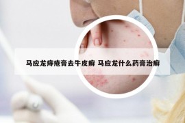 马应龙痔疮膏去牛皮癣 马应龙什么药膏治癣