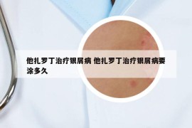 他扎罗丁治疗银屑病 他扎罗丁治疗银屑病要涂多久