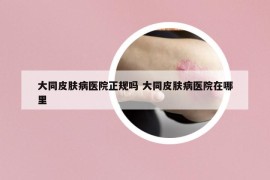 大同皮肤病医院正规吗 大同皮肤病医院在哪里