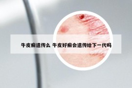 牛皮癣遗传么 牛皮好癣会遗传给下一代吗