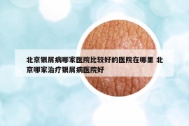 北京银屑病哪家医院比较好的医院在哪里 北京哪家治疗银屑病医院好