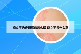 癣立王治疗银屑病怎么样 藓立王是什么药