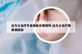 达力士治疗牛皮癣能长期用吗 达力士治疗银屑病经验