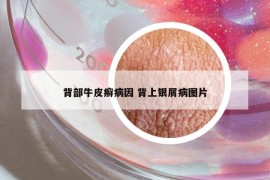 背部牛皮癣病因 背上银屑病图片