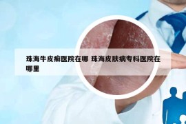 珠海牛皮癣医院在哪 珠海皮肤病专科医院在哪里