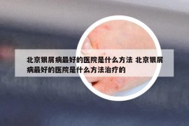 北京银屑病最好的医院是什么方法 北京银屑病最好的医院是什么方法治疗的