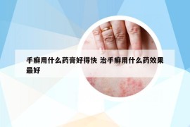 手癣用什么药膏好得快 治手癣用什么药效果最好