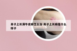 鼻子上长满牛皮癣怎么治 鼻子上长癣是什么样子