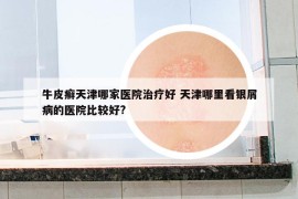 牛皮癣天津哪家医院治疗好 天津哪里看银屑病的医院比较好?