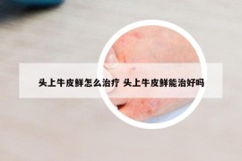 头上牛皮鲜怎么治疗 头上牛皮鲜能治好吗