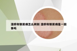 湿疹和银屑病怎么辨别 湿疹和银屑病是一回事吗