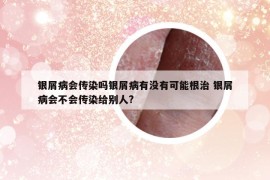 银屑病会传染吗银屑病有没有可能根治 银屑病会不会传染给别人?