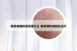 银屑病病的症状是什么 银屑病的病因及治疗