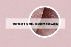 银屑病属于医保吗 银屑病是否纳入医保