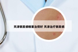 天津银屑病哪里治得好 天津治疗银屑病