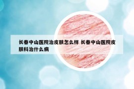 长春中山医院治皮肤怎么样 长春中山医院皮肤科治什么病