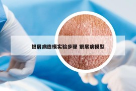 银屑病造模实验步骤 银屑病模型