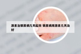 激素治银屑病几天起效 银屑病用激素几天治好