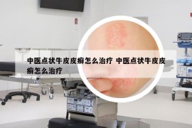 中医点状牛皮皮癣怎么治疗 中医点状牛皮皮癣怎么治疗