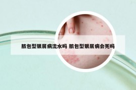 脓包型银屑病流水吗 脓包型银屑病会死吗