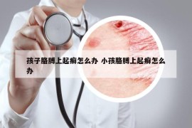 孩子胳膊上起癣怎么办 小孩胳膊上起癣怎么办