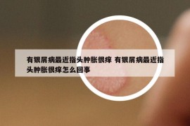 有银屑病最近指头肿胀很痒 有银屑病最近指头肿胀很痒怎么回事