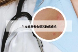 牛皮癣患者会得其他癌症吗