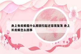 身上有皮癣是什么原因引起还容易复发 身上长皮癣怎么回事