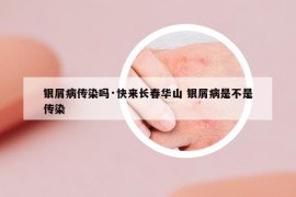 银屑病传染吗·快来长春华山 银屑病是不是传染