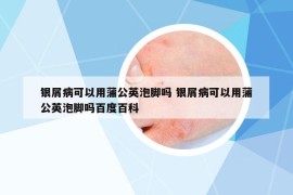 银屑病可以用蒲公英泡脚吗 银屑病可以用蒲公英泡脚吗百度百科