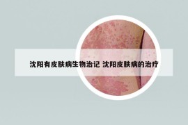 沈阳有皮肤病生物治记 沈阳皮肤病的治疗