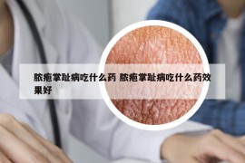 脓疱掌趾病吃什么药 脓疱掌趾病吃什么药效果好