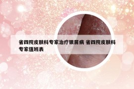 省四院皮肤科专家治疗银屑病 省四院皮肤科专家值班表