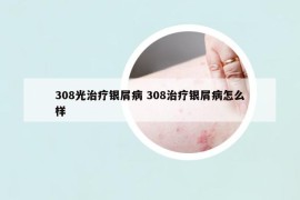 308光治疗银屑病 308治疗银屑病怎么样